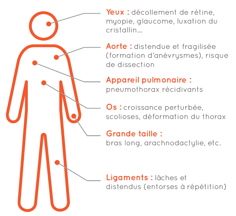 Schéma du syndrome de marfan